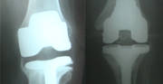 Eight Facts about Revision Knee Replacement Eight Facts about Revision Knee Replacement